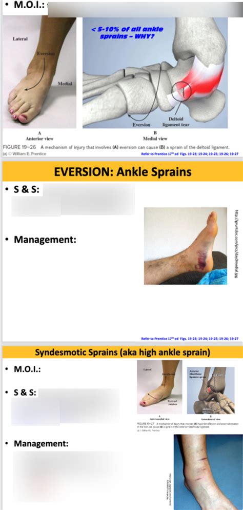 test for interosse membrane tear|Syndesmotic Ankle Sprains .